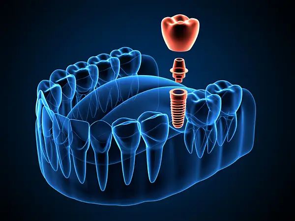  A whole mouth 3D rendering of a dental implant 